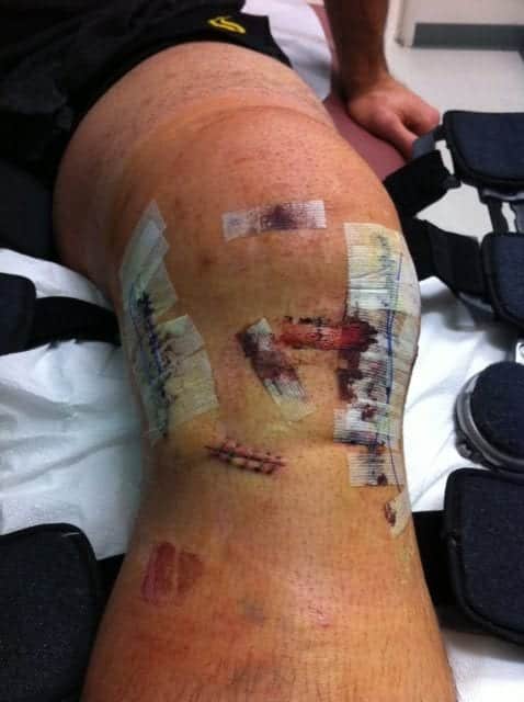 Forrest_s_knee