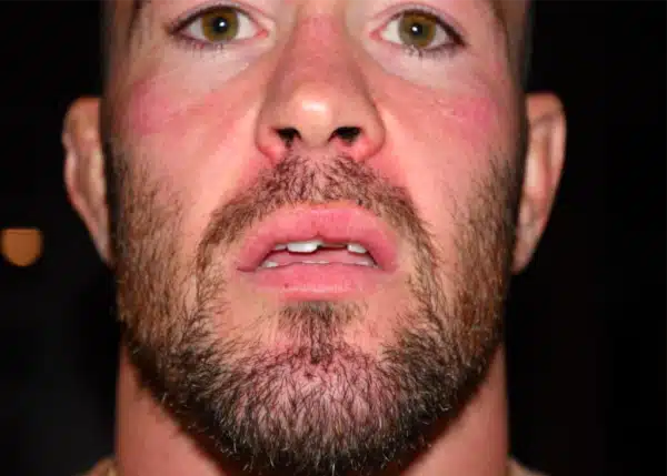 colby-covington-chipped-tooth-after-masvidal-attack